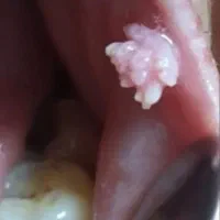 درمان ریشه ای زگیل و خال گوشتی درکمتر از ۲هفته