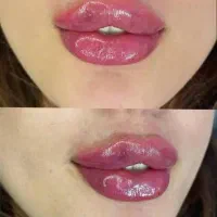 ژل بوتاکس|خدمات آرایشگری و زیبایی|اهواز, پادادشهر|دیوار