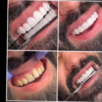 تزریق ژل و بوتاکس و لیفت صورت و کامپوزیت