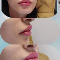 ژل لب زاویه فک و چانه هر سی سی ۵۸۰ ب مدت محدود