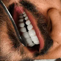 کامپوزیت لمینیت درمان دندان|خدمات زیبایی و سلامت|تهران, دریا|دیوار
