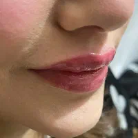 ژل لب بوتاکس