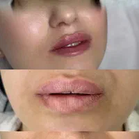 تخفیف ویژه روی کلیه کارهای زیبایی فیلر و بوتاکس|خدمات آرایشگری و زیبایی|شیراز, تاچارا|دیوار