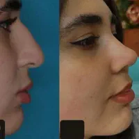 بدون عمل وبدون درد بینیتون را خوش فرم کنید