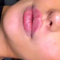 جشنواره تخفیف ویژه تزریق ژل و بوتاکس