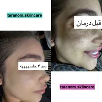 رفع تمامی ککومکها تنها در یک جلسه