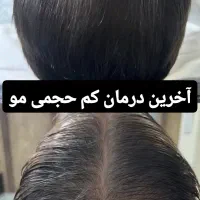 (میکرواسکالپ /اسکالپ) رفع کم حجمی مو در کلینیک