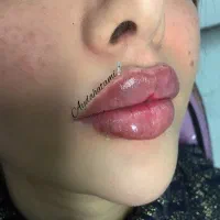 تزریق ژل و بوتاکس توسط پیرا پزشک مجرب|خدمات آرایشگری و زیبایی|اهواز, پادادشهر|دیوار