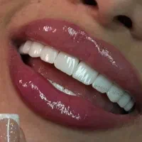 کامپوزیت دندان لمینت پیش پرداخت با سفته