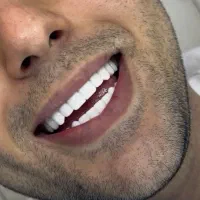 کامپوزیت دندان بابهترین موادفقط وفقط واحدی۹۹۹