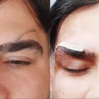 عمل لیفت ابرو وشقیقه جراحی ۸م بوتاکس مصپورت ۶۰۰