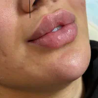 تزریق ژل بوتاکس فیلر لیزرجوانساز مزو مطب زیبایی