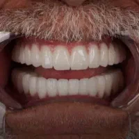 جشنواره دندانپزشکی مرکز تخصصی ایمپلنت و اوردنچر|خدمات آرایشگری و زیبایی|ماکو, |دیوار