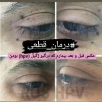 درمان ریشه ای تبخال و زگیل تناسلی با گیاهان دارویی|خدمات آرایشگری و زیبایی|اهواز, گلستان|دیوار