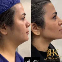 بوکال فت/ ساکشن غبغب / چال گونه/پزشک متخصص