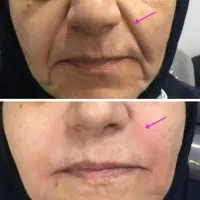 پماد سوپر کلاژن اقساطی