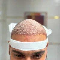 کاشت مو و ابرو و تخفیف ویژه و تمام اقساط