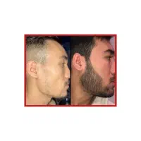 ریش ، سیبیل ، الوپسی ، ریزش سکه ای