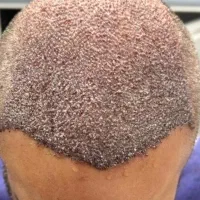 کاشت مو /کاشتمو/کاشتمو شیراز|خدمات آرایشگری و زیبایی|شیراز, قصرالدشت|دیوار