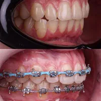 ارتودنسی ثابت و متحرک با اقساط بلند مدت|خدمات آرایشگری و زیبایی|میانه, |دیوار