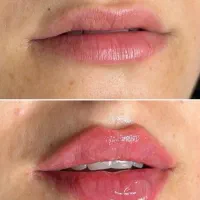 تزریق ژل و بوتاکس(اقساطی)توسط پزشک حتی امروز