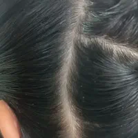 پاکسازی مو از بیماری شپش.