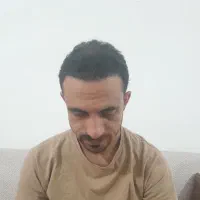 کاشت مو فقط ۱۰ میلیون در تهران