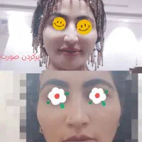 تزریق ژل .بوتاکس .انزیم بینی .مزوژل جوانساز