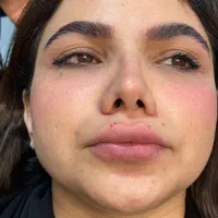 ژل و بوتاکس تضمینی بهترین متریال