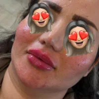 ژل و‌بوتاکس بانوان و آقایون