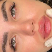 خدمات ژل بوتاکس فیلر|خدمات زیبایی و سلامت|اصفهان, سیچان|دیوار