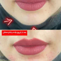 تزریقات. و جوانسازی پوست با فیلر و بوتاکس|آرایشی، بهداشتی، درمانی|اهواز, زیتون کارگری|دیوار