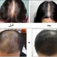 محلول و درمان رشد موی سر کاملا گیاهی|آرایشی، بهداشتی، درمانی|مهاباد (آذربایجان غربی), |دیوار