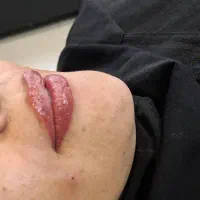 تزریق تخصصی مزو آنزیم فیلر بوتاکس فیلربادی