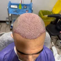 کاشت مو و ابرو میکرو کاشت (رایگان)|خدمات زیبایی و سلامت|تهران, مرزداران|دیوار