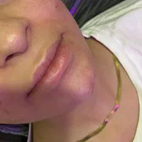 تخفیف جشنواره فیلر ژل لب و صورت یافت اباد فلاح|خدمات آرایشگری و زیبایی|تهران, تولید دارو|دیوار