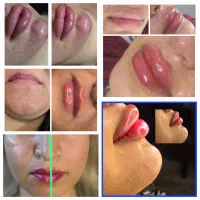 تزریق ژل بوتاکس کامپوزیت