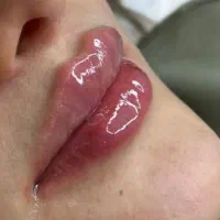 آموزش فیلر و بوتاکس