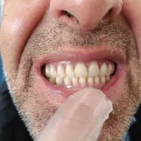 دندان مصنوعی