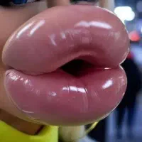 آموزش تزریق ژل ، بوتاکس،مزوو..