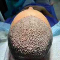 کاشت تخصصی مو در شیراز|خدمات آرایشگری و زیبایی|بوشهر, |دیوار