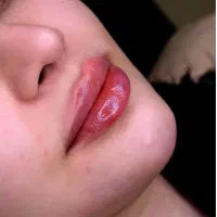 تزریق فیلر و بوتاکس توسط پزشک در کلینیک زیبایی|خدمات آرایشگری و زیبایی|قم, نیروگاه|دیوار