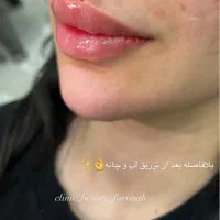 آف فیلر و بوتاکس فقطط۵۸۰|خدمات آرایشگری و زیبایی|ایذه, |دیوار