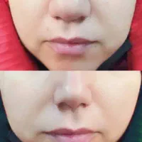 تخفیف ویژه کوچک کردن بینی،آنزیم غبغب، فیلر|خدمات آرایشگری و زیبایی|مشهد, آزادشهر|دیوار