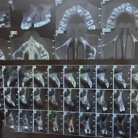 سینوس لیفت رایگان