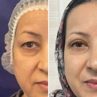 لیفت شقیقه یا بلفاروپلاستی با جراحی