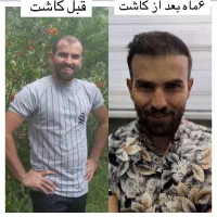 کاشت مو زیر ۱۰ میلیون بیمارستان فوق تخصصی پاستور|خدمات آرایشگری و زیبایی|قزوین, |دیوار