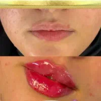 جشنواره آموزش ژل بوتاکس کمترین هزینه هفده شهریور