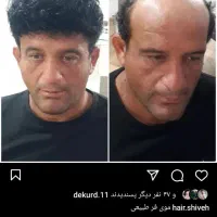 ترمیم مو و پروتز مو سجادی