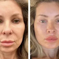 جشنواره اندولیفت تخصصی صورت وگردن|خدمات آرایشگری و زیبایی|تهران, جماران (نیاوران)|دیوار